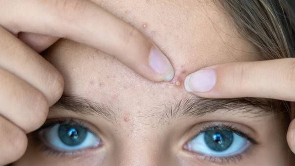 Pesquisas com tecnologia de RNA mensageiro apontam para uma possível vacina contra a acne, mas o ceticismo em relação às vacinas e desafios científicos ainda são obstáculos no caminho