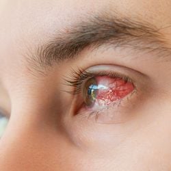 Conjuntivite viral, ceratite por exposição ao sol, blefarite, terçol e síndrome do olho seco são algumas das condições mais frequentes