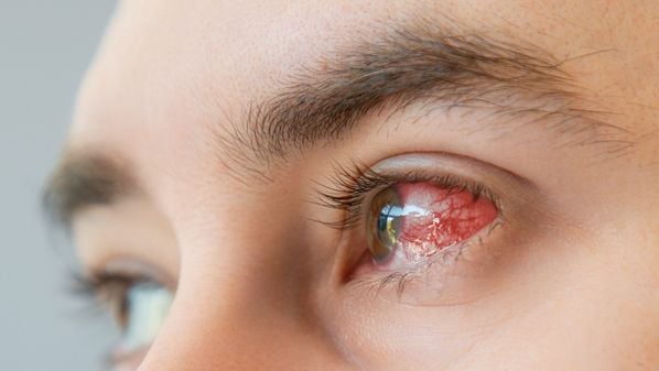 Conjuntivite viral, ceratite por exposição ao sol, blefarite, terçol e síndrome do olho seco são algumas das condições mais frequentes