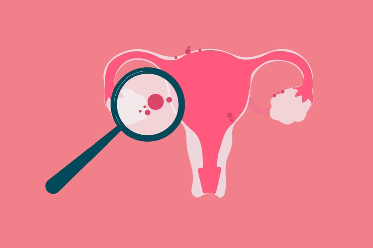 Com sintomas confundidos com outras condições, a endometriose exige acompanhamento especializado (Imagem: Gegambar | Shutterstock)