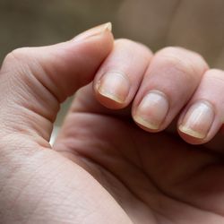 A unha com fungos apresenta uma coloração diferente, como amarelo, branco ou verde. Ela também pode ficar mais espessa, se descolar com facilidade e se tornar quebradiça