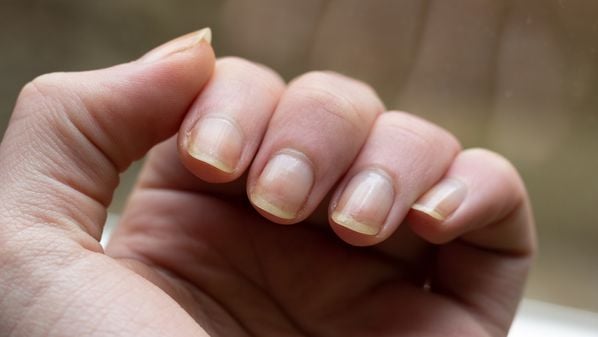 Os sintomas da micose incluem alterações na aparência das unhas, como espessamento, coloração alterada, deformidade, descolamento e fragilidade