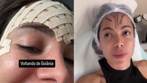 Nesta terça-feira (10), a cantora publicou vídeos nas redes sociais com curativos na cabeça, em uma maca de hospital