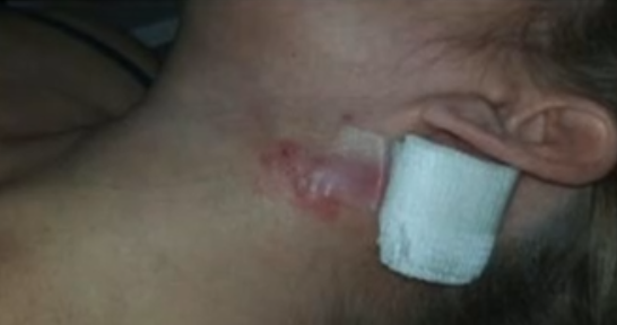 Pacientes ficaram com marcas no rosto após procedimentos em clínica de Vitória