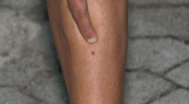 Ferimento causado por um dos estilhaços que atingiram o empresário