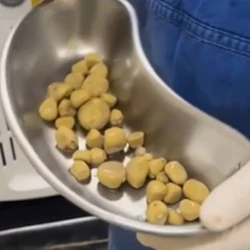 A principal causa para a formação dessa quantidade de cálculos está relacionada ao alto consumo de refrigerantes, que chegava a superar os dois litros por dia