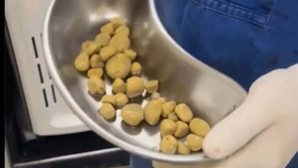 A principal causa para a formação dessa quantidade de cálculos está relacionada ao alto consumo de refrigerantes, que chegava a superar os dois litros por dia