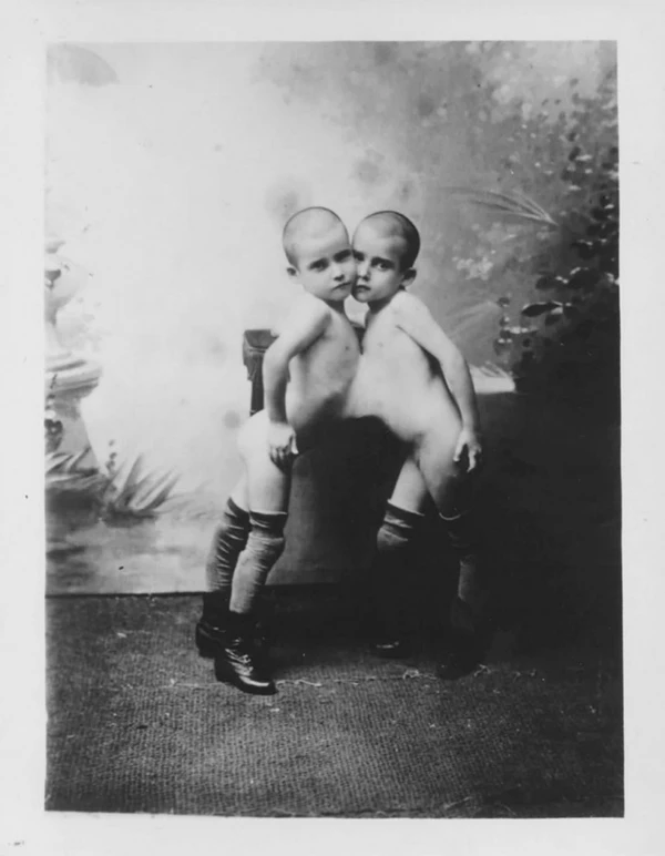 Fotos de 1900 mostram as gêmeas siamesas por Reprodução / Arquivo Público Mineiro / A. Larrete