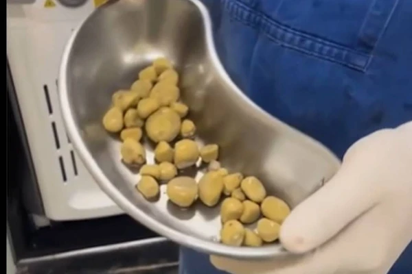 Os cálculos (pedras) na bexiga tem origem no alto consumo de refrigerantes