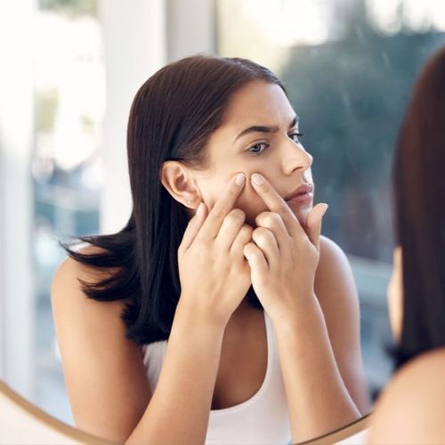 Imagem - 7 dicas para controlar a acne na vida adulta