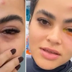 Vídeos tiveram mais de 16 milhões de visualizações nas redes sociais; jovem recebeu o diagnóstico de quemose ocular