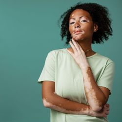 Doença é caracterizada pela perda de pigmentação da pele devido à diminuição da produção de melanina
