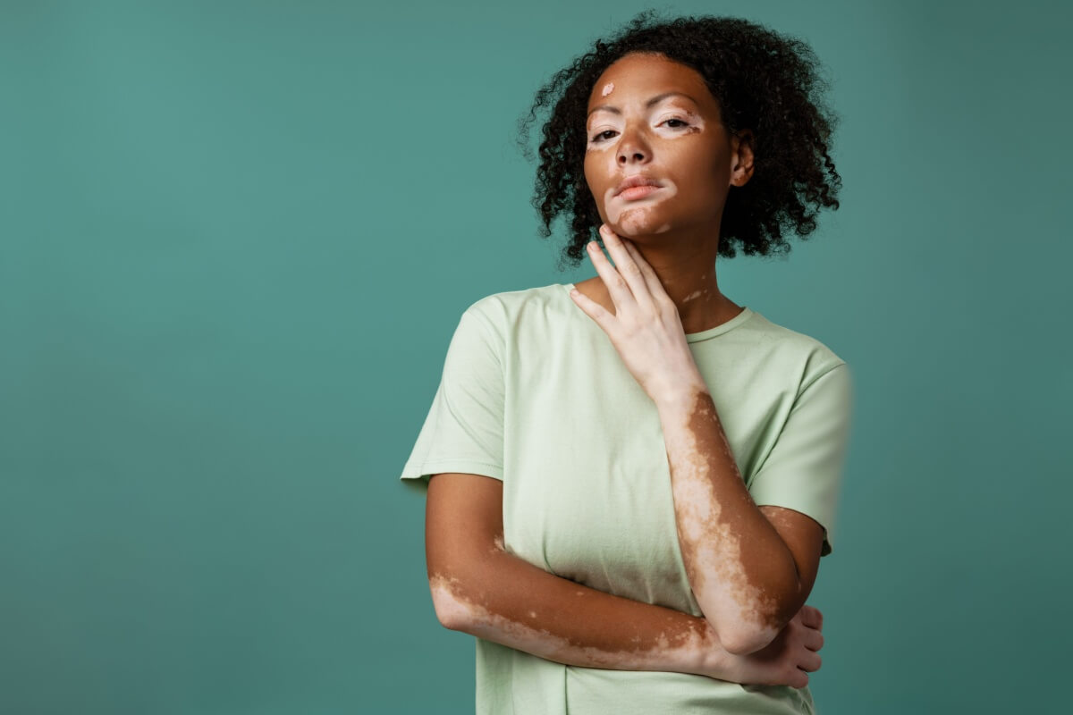 O vitiligo é caracterizado por áreas despigmentadas na pele (Imagem: Dean Drobot | Shutterstock)