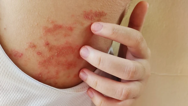 A condição se manifesta através de uma pele cronicamente seca e pelo surgimento de lesões avermelhadas e ásperas, conhecidas como eczemas