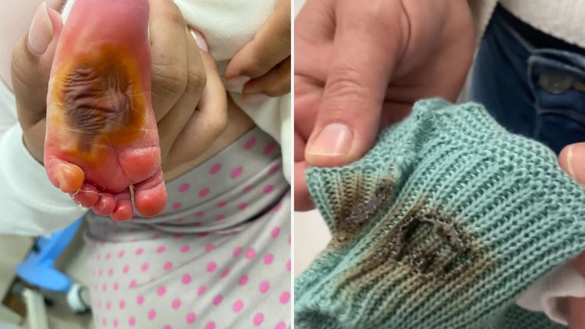 A família de José afirma que ele teve o pé queimado enquanto estava em berço aquecedor no Hospital Estadual Dr. Jayme dos Santos Neves.