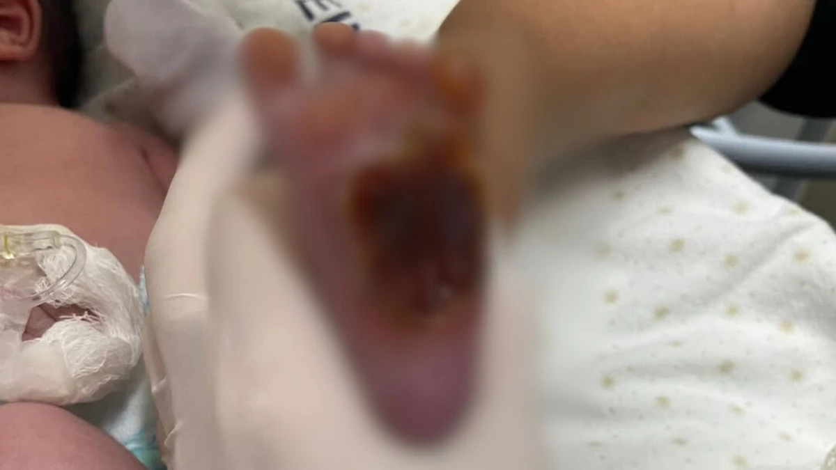 Bebe teve pé queimado dentro de hospital na Serra