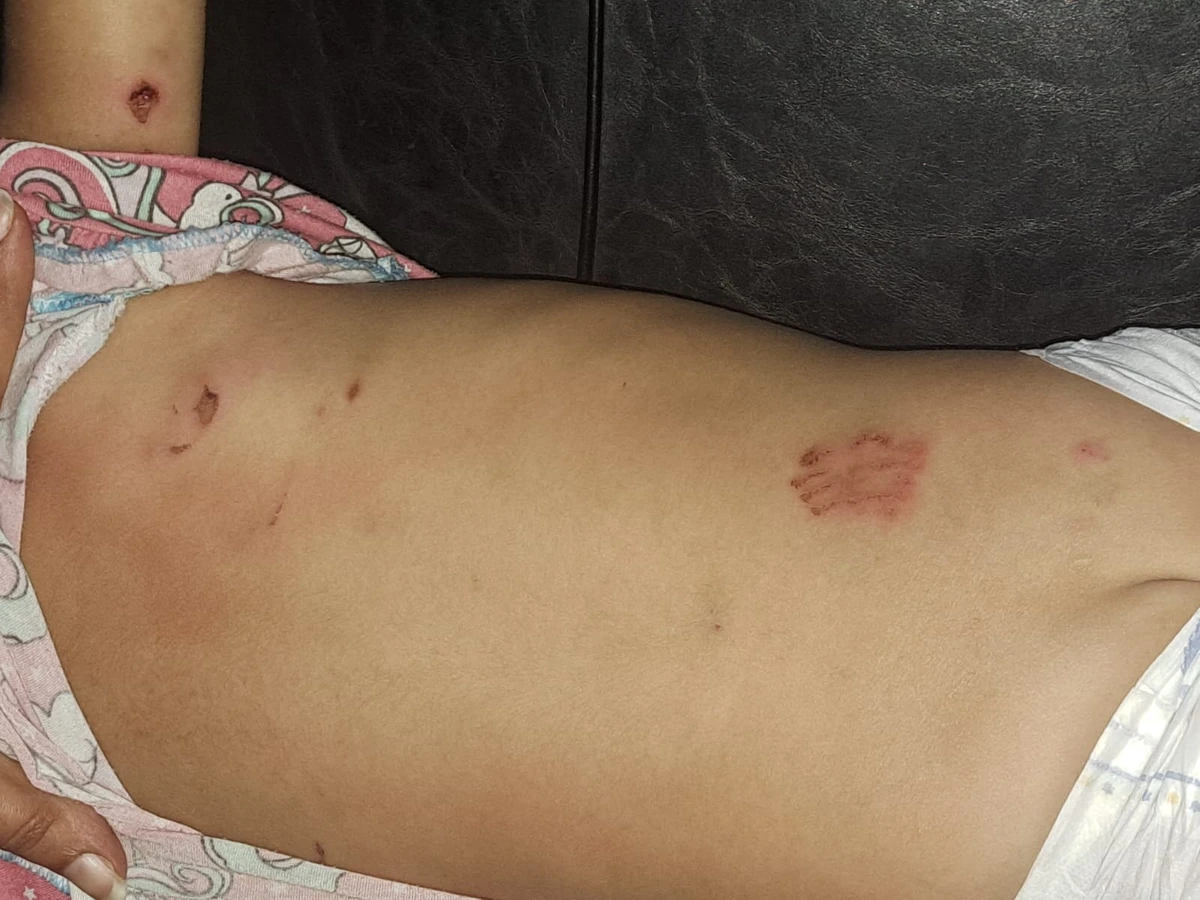 A menina só foi vacinada contra raiva na manhã desta terça (09)