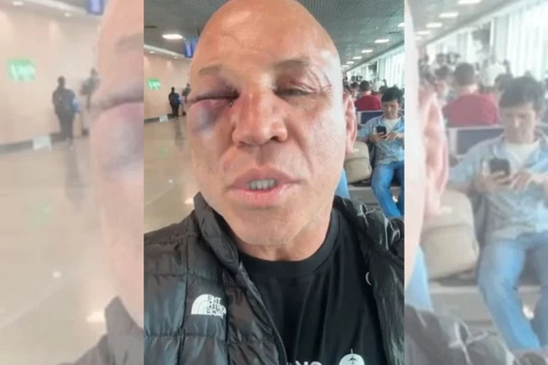 Wanderlei Silva teve uma lesão grave no olho e fraturou o nariz após ser desclassificado na luta contra Popó