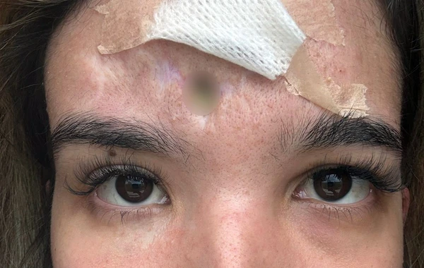 A pele da testa da advogada Michaella Zukoski, atingida por uma pedra em 2023, 