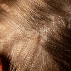 Saiba o que é, como afeta o cabelo e a transição capilar e como tratar os fios capilares.