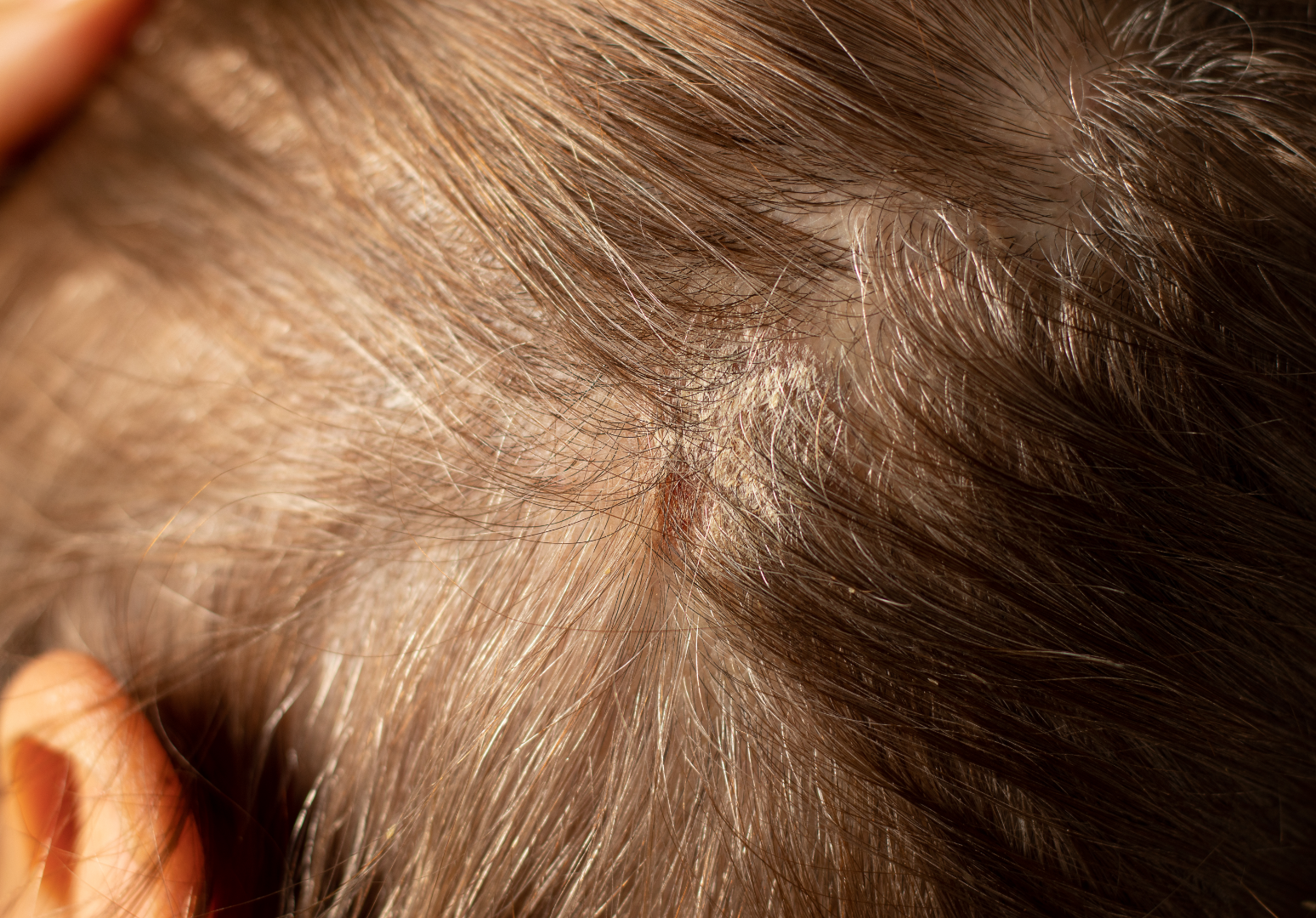 Entenda o que é o Scab Hair e como evitá-lo. Crédito: Canva