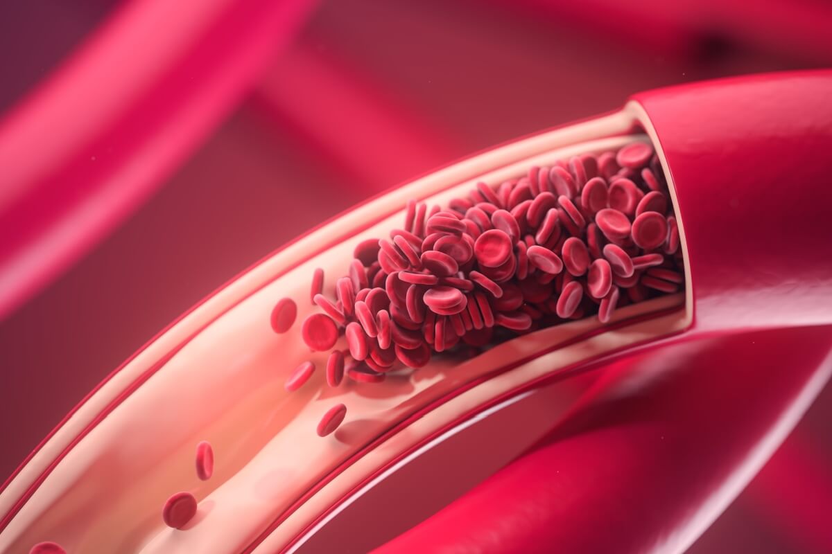 A combinação de calor e imobilidade prolongada eleva o risco de trombose (Imagem: KateStudio | Shutterstock)