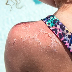 A queimadura solar é uma reação inflamatória aguda da pele, provocada pela exposição prolongada aos raios ultravioleta (UV) do sol, sem a proteção adequada