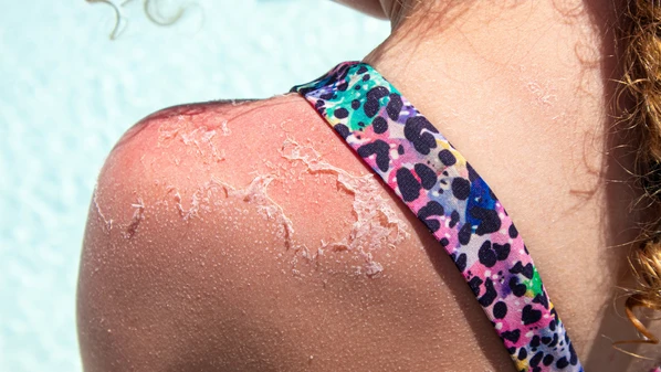 A queimadura solar é uma reação inflamatória aguda da pele, provocada pela exposição prolongada aos raios ultravioleta (UV) do sol, sem a proteção adequada