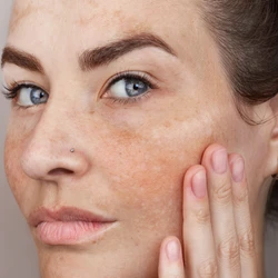 As manchas de sol são alterações na coloração da pele causadas principalmente pela exposição ao sol ao longo da vida, mas também pelo processo de envelhecimento