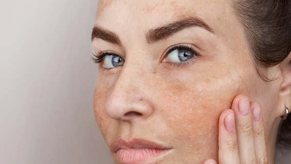 As manchas de sol são alterações na coloração da pele causadas principalmente pela exposição ao sol ao longo da vida, mas também pelo processo de envelhecimento