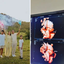 Condição em que a criança nasce envolta pela bolsa amniótica é considerada rara no mundo da obstetrícia, segundo especialistas