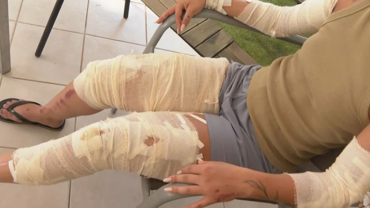 Mulher ficou com a maior parte do corpo em carne viva após o crime