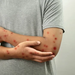 Febre e calafrios, dor de cabeça intensa, dores musculares e ínguas (linfonodos inchados) são alguns dos sintomas