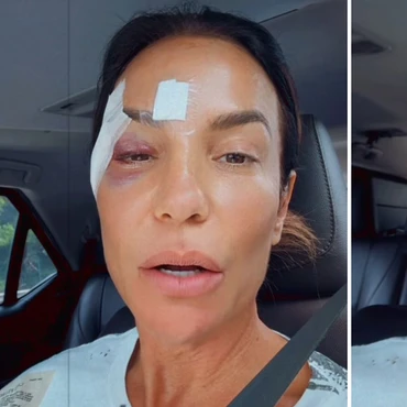 Imagem - Ivete Sangalo deixa hospital com olho roxo e tranquiliza fãs