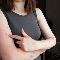 O principal sintoma é o aparecimento súbito de lesões na pele, que podem ser únicas ou múltiplas, em qualquer parte do corpo, inclusive na região genital