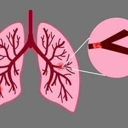 Condição é considerada uma emergência médica, exigindo diagnóstico e tratamento rápidos para evitar complicações