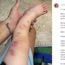 Pais receberam um comunicado informando que o filho havia sido mordido, mas se surpreenderam ao ver a quantidade de marcas no corpo do menino