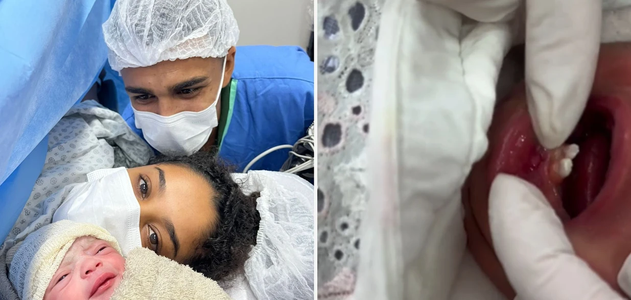 A pequena Izabella fez a extração aos seis dias de vida e o procedimento durou cerca de 10 minutos. Entenda o caso raro ocorrido no Espírito Santo