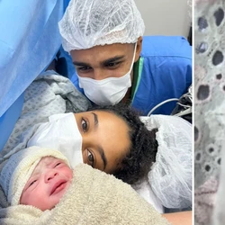 A pequena Izabella fez a extração aos seis dias de vida e o procedimento durou cerca de 10 minutos. Entenda o caso raro ocorrido no Espírito Santo