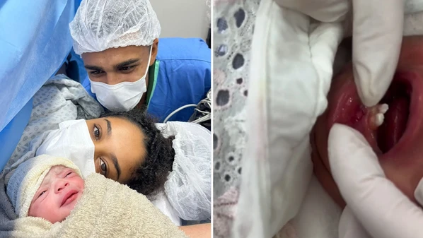 A pequena Izabella fez a extração aos seis dias de vida e o procedimento durou cerca de 10 minutos. Entenda o caso raro ocorrido no Espírito Santo