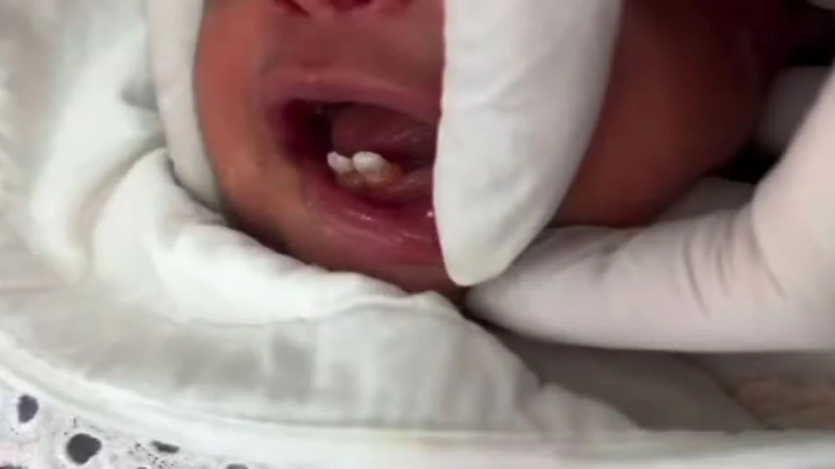 Caso de recém nascido com dentes é considerado raro, segundo especialista