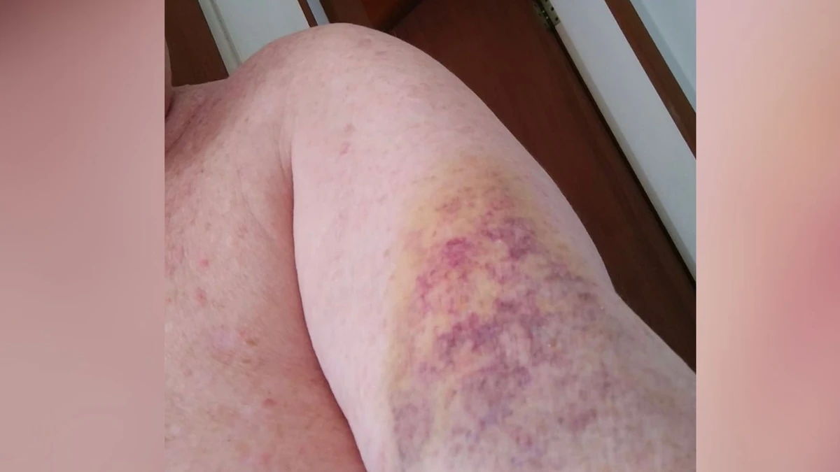 Idoso ficou com o braço roxo após ciclista o socar 11 vezes em desentendimento no  trânsito em Jardim Camburi, em Vitória