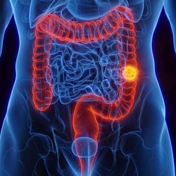 Embora os mais velhos continuem a representar a maioria dos casos de câncer colorretal, as taxas começaram a subir com rapidez entre indivíduos mais jovens