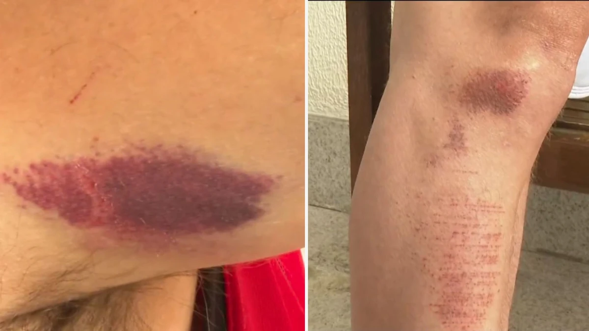 Idoso ficou com hematomas no braço e na perna