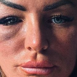 A escocesa Anne Marie Boyle teve lesão cerebral e passou a sofrer convulsões que a levaram a perder seu trabalho, sua carta de motorista e sua autoconfiança, após levar um soco de um lutador de muay thai.